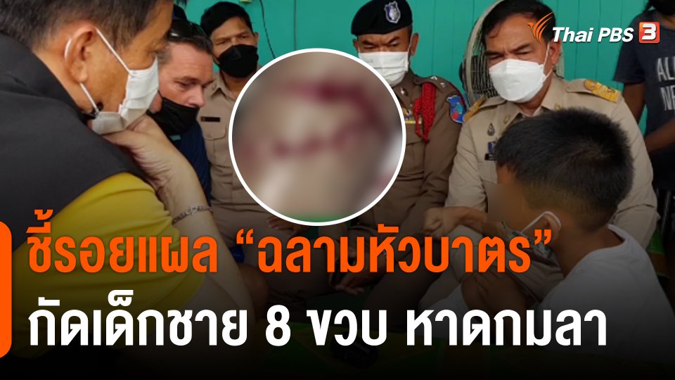 ชี้รอยแผล "ฉลามหัวบาตร" กัดเด็กชาย 8 ขวบ หาดกมลา จ.ภูเก็ต