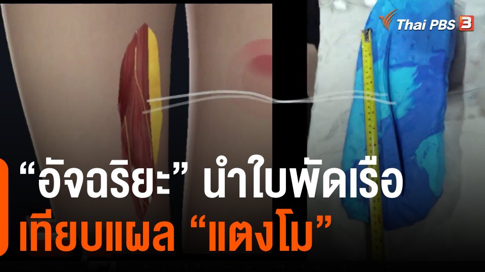 ​"อัจฉริยะ" นำใบพัดเรือเทียบแผล "แตงโม"