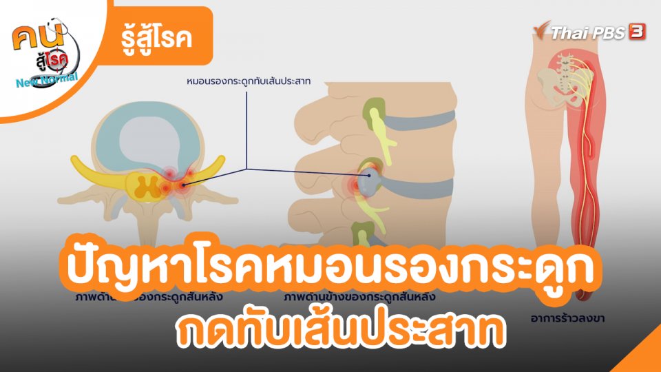 ​รู้สู้โรค : ปัญหาโรคหมอนรองกระดูกกดทับเส้นประสาท