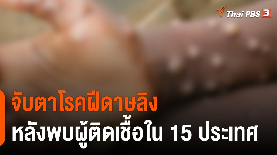 วิเคราะห์สถานการณ์ต่างประเทศ : จับตาโรคฝีดาษลิงหลังพบผู้ติดเชื้อใน 15 ประเทศ