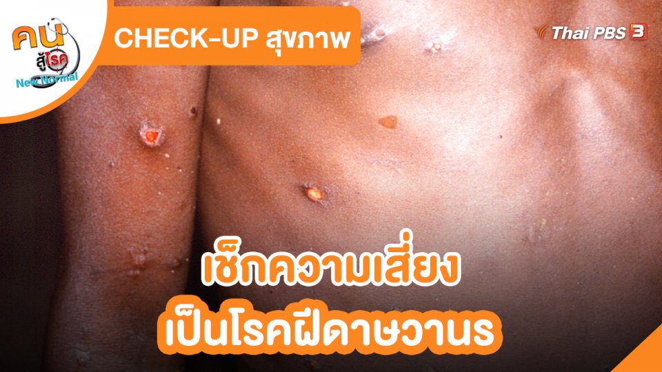 ​Check up สุขภาพ : เช็กความเสี่ยงเป็นโรคฝีดาษวานร​