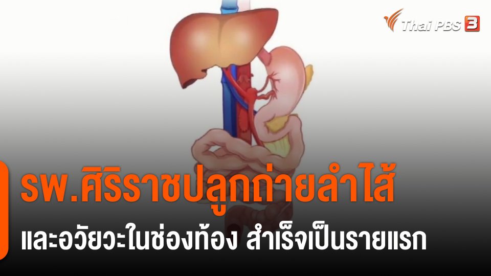 ​รพ.ศิริราชปลูกถ่ายลำไส้และอวัยวะในช่องท้อง สำเร็จเป็นรายแรก