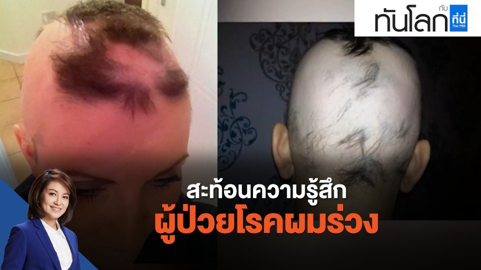 สะท้อนความรู้สึกผู้ป่วยโรคผมร่วง