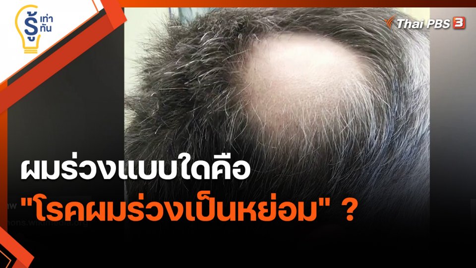​รู้เท่ารู้ทัน : ผมร่วงแบบใดคือ "โรคผมร่วงเป็นหย่อม" ?