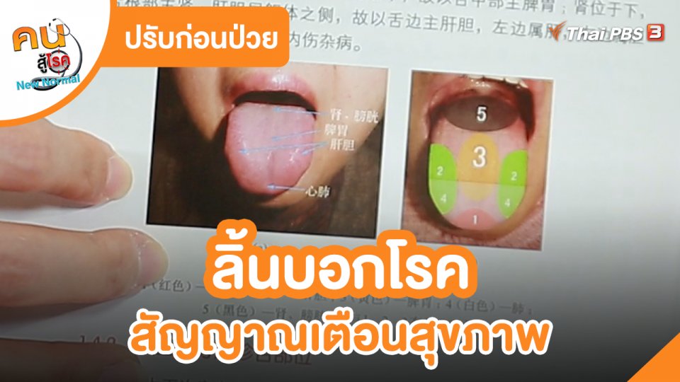 ปรับก่อนป่วย : ลิ้นบอกโรค