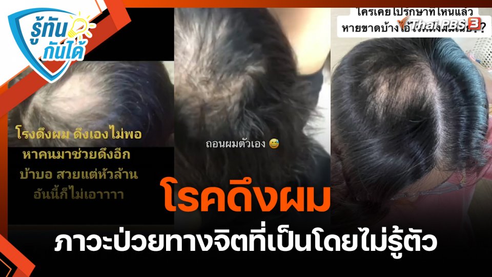 รู้ทันกันได้ : “โรคดึงผม” ภาวะป่วยทางจิตที่เป็นโดยไม่รู้ตัว