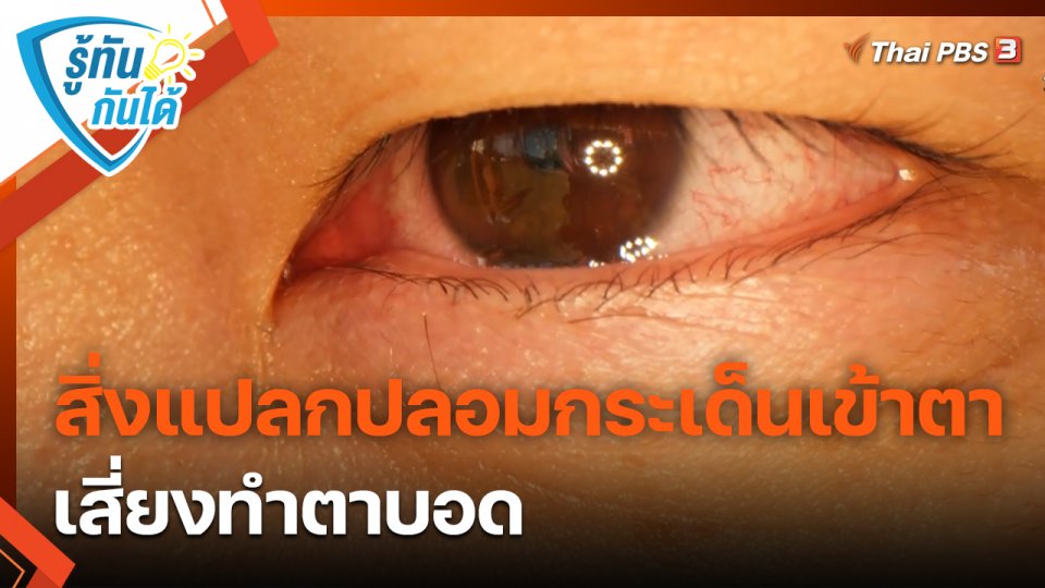 รู้ทันกันได้ : สิ่งแปลกปลอมกระเด็นเข้าตา เสี่ยงทำตาบอด