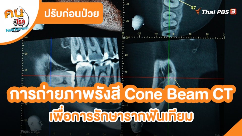 ปรับก่อนป่วย : การถ่ายภาพรังสี Cone Beam CT เพื่อการรักษารากฟันเทียม