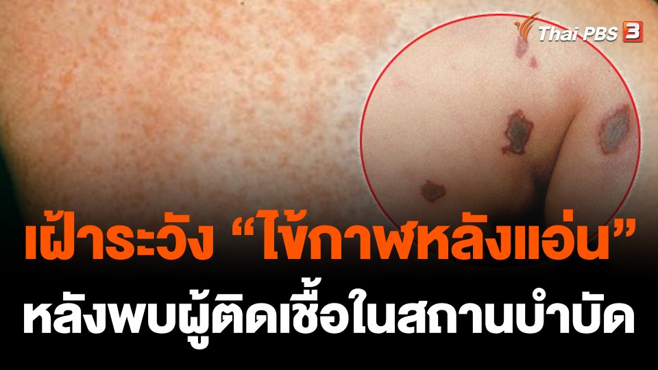 เฝ้าระวัง “ไข้กาฬหลังแอ่น” หลังพบผู้ติดเชื้อในสถานบำบัด จ.กระบี่