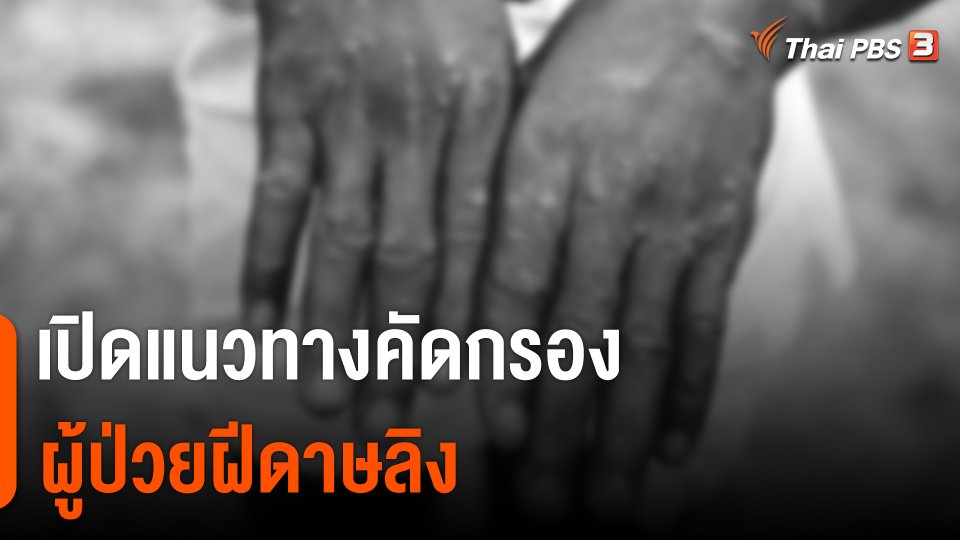 กรมควบคุมโรค เปิดแนวทางคัดกรองผู้ป่วยฝีดาษลิง