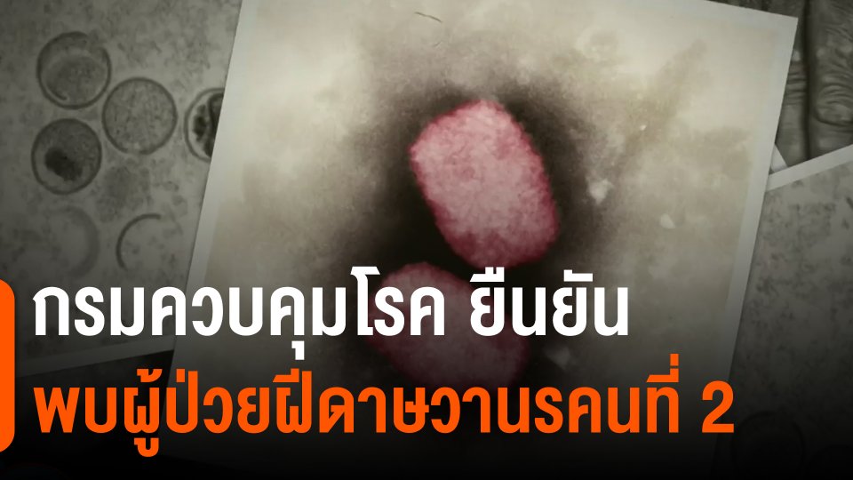 ​กรมควบคุมโรค ยืนยันพบผู้ป่วยฝีดาษวานรคนที่ 2