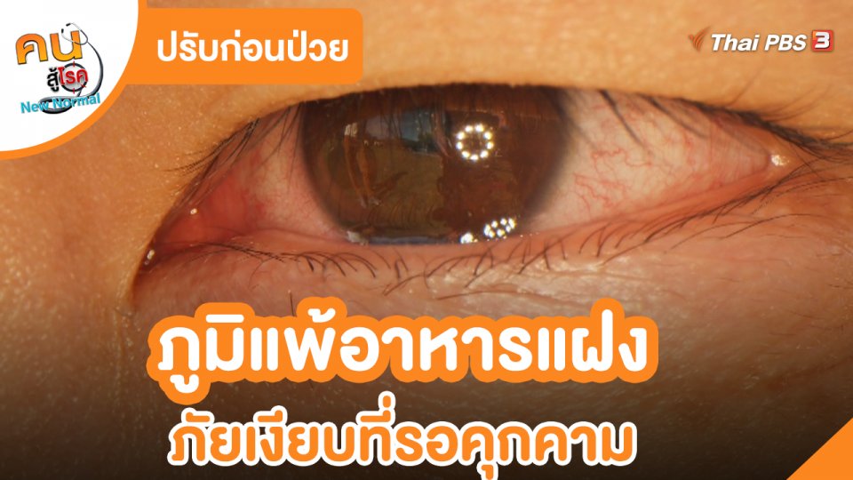 ปรับก่อนป่วย : ภูมิแพ้อาหารแฝง ภัยเงียบที่รอคุกคาม