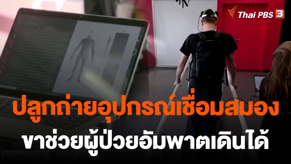 ปลูกถ่ายอุปกรณ์เชื่อมสมอง - ขาช่วยผู้ป่วยอัมพาตเดินได้