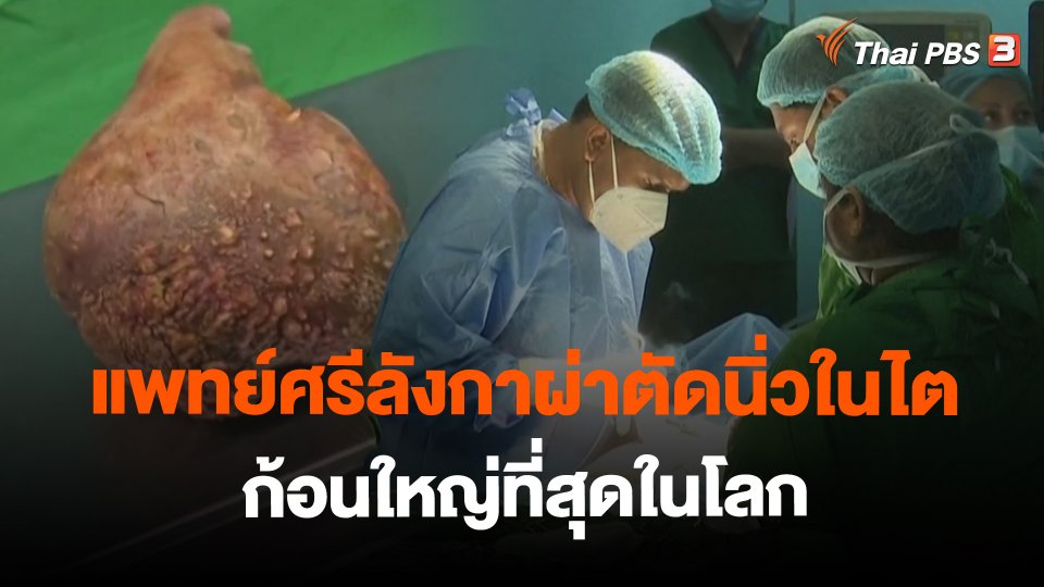 แพทย์ศรีลังกาผ่าตัดนิ่วในไตก้อนใหญ่ที่สุดในโลก