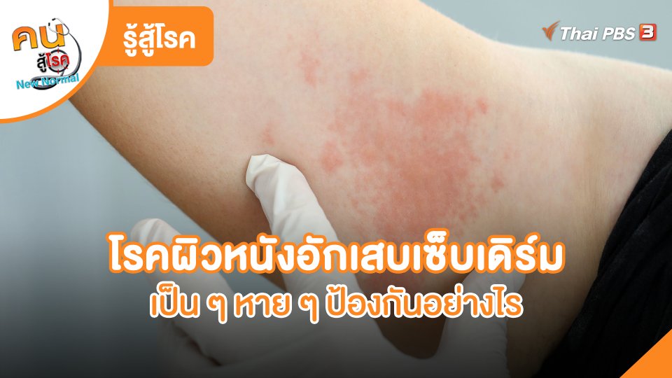 รู้สู้โรค : โรคผิวหนังอักเสบเซ็บเดิร์มเป็น ๆ หาย ๆ ป้องกันอย่างไร