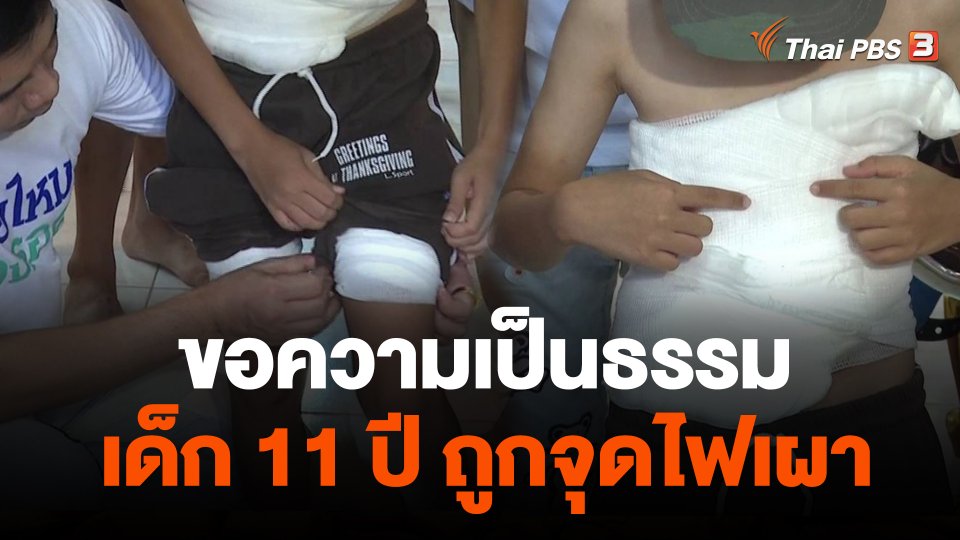 ขอความเป็นธรรมเด็ก 11 ปี ถูกจุดไฟเผา