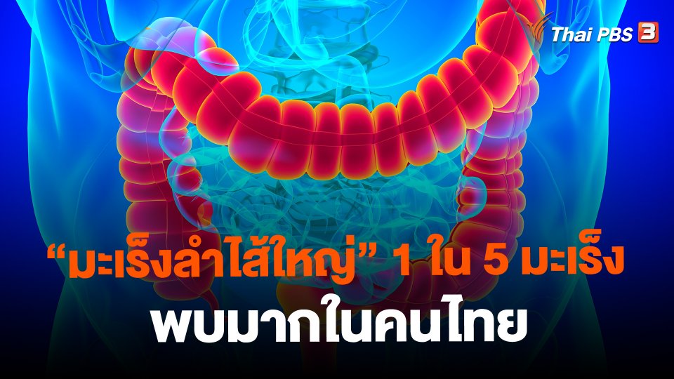 ​"มะเร็งลำไส้ใหญ่" 1 ใน 5 มะเร็ง พบมากในคนไทย