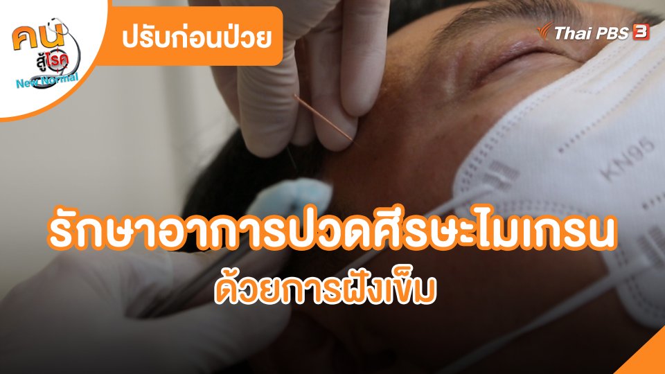 ปรับก่อนป่วย : รักษาอาการปวดศีรษะไมเกรนด้วยการฝังเข็ม