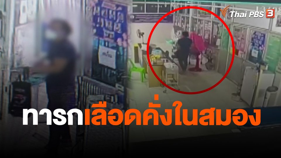 ​ทารกเลือดคั่งในสมอง