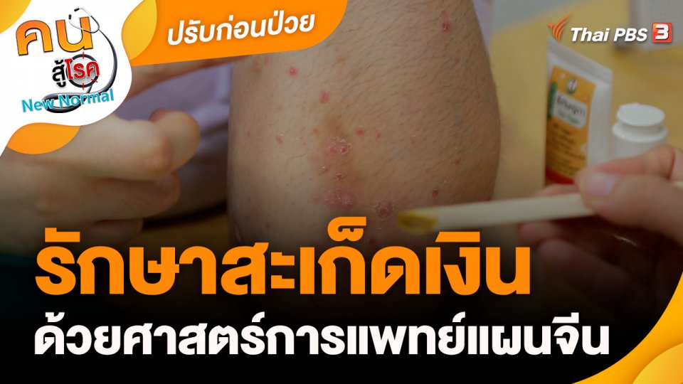 ปรับก่อนป่วย : รักษาสะเก็ดเงินด้วยศาสตร์การแพทย์แผนจีน