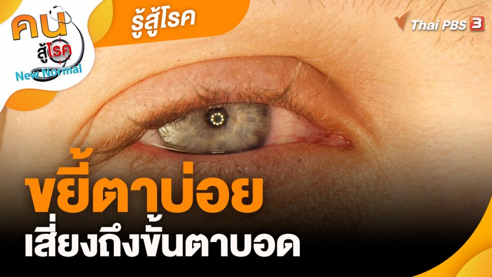 ​รู้สู้โรค : ขยี้ตาบ่อยเสี่ยงถึงขั้นตาบอด
