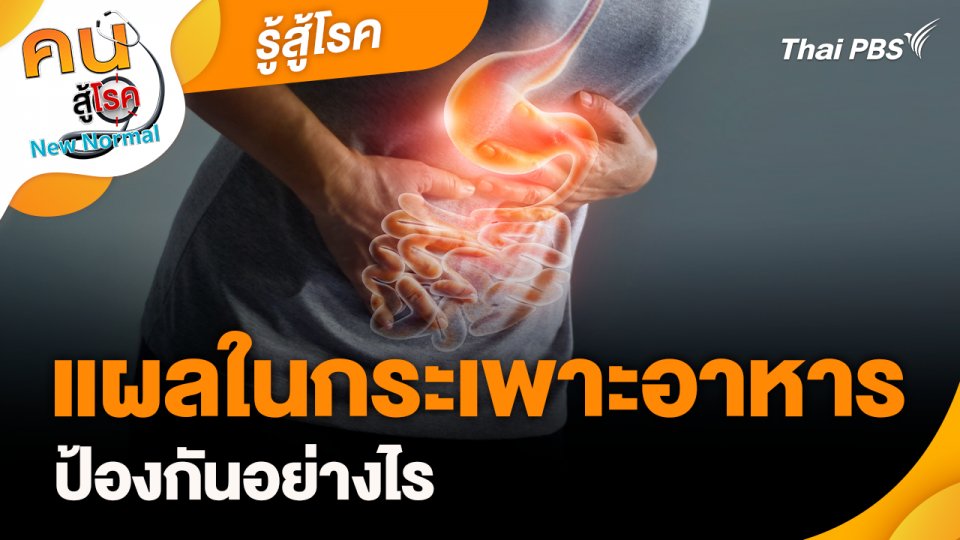 รู้สู้โรค : แผลในกระเพาะอาหารป้องกันอย่างไร