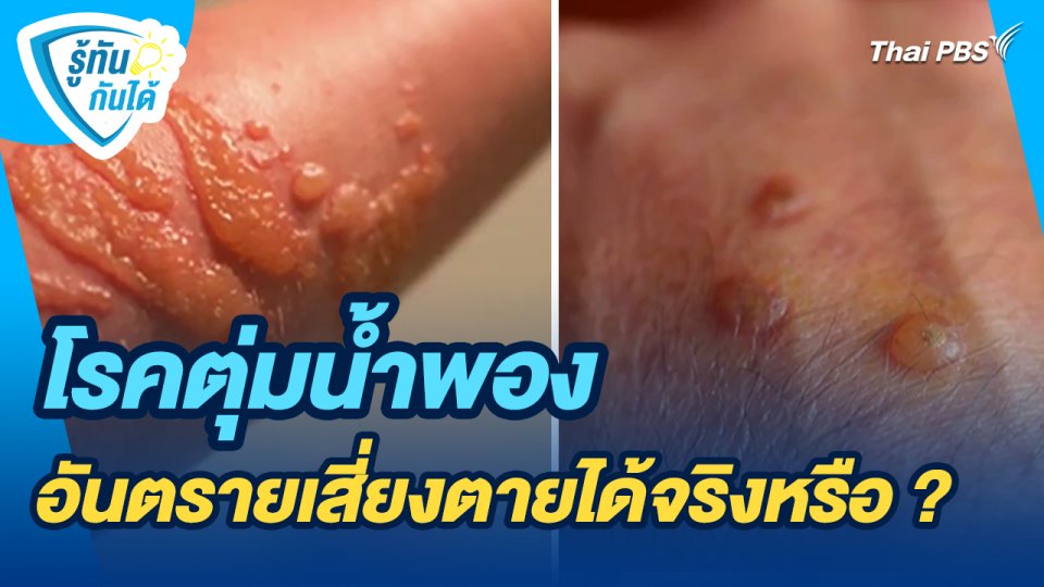 รู้ทันกันได้ : โรคตุ่มน้ำพอง อันตรายเสี่ยงตายได้จริงหรือ ?
