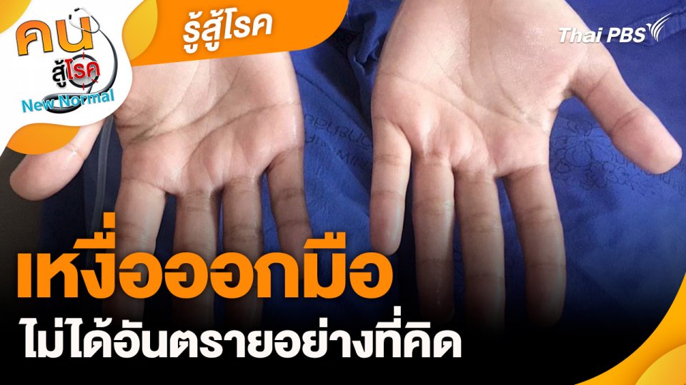 รู้สู้โรค : เหงื่อออกมือ