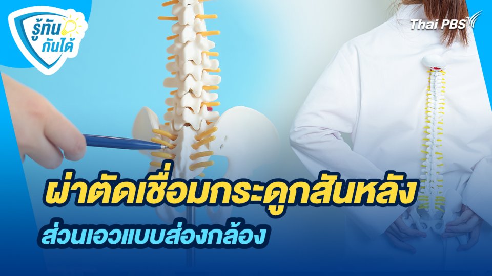 รู้ทันกันได้ : ผ่าตัดเชื่อมกระดูกสันหลังส่วนเอวแบบส่องกล้อง