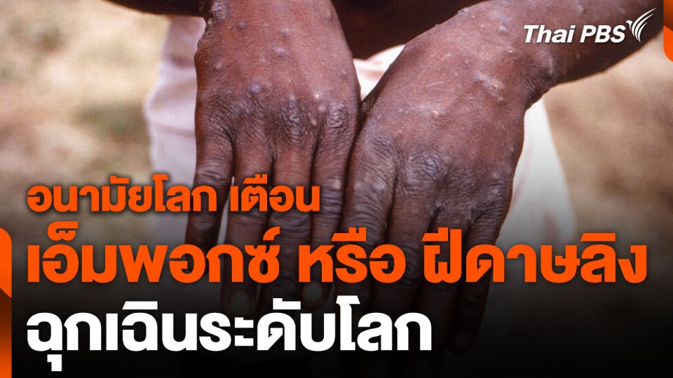 อนามัยโลก เตือน "เอ็มพอกซ์" หรือ "ฝีดาษลิง" ฉุกเฉินระดับโลก
