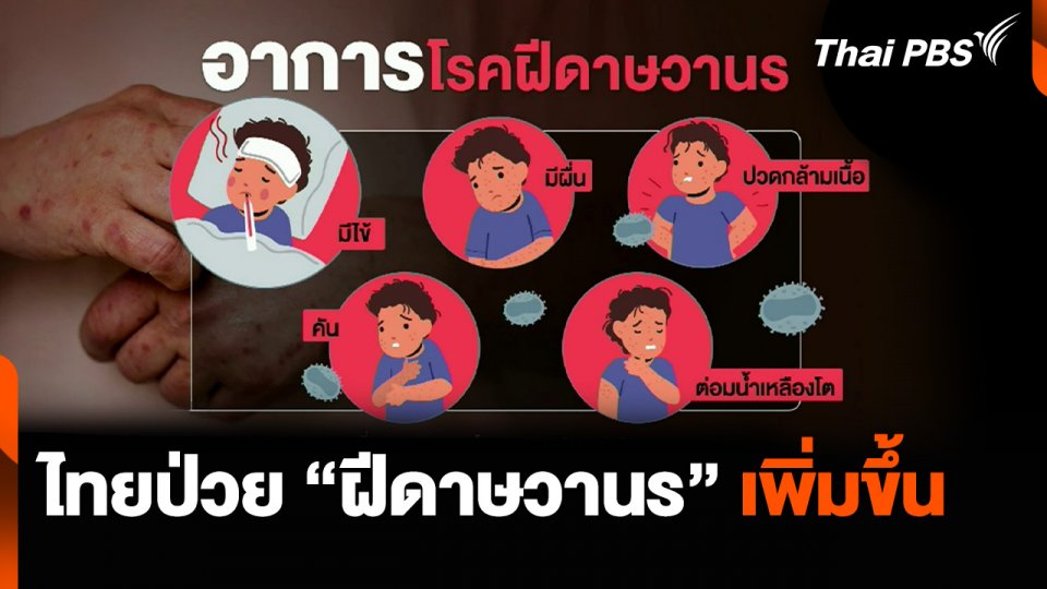 ไทยเจอผู้ป่วย “โรคฝีดาษวานร” เพิ่มขึ้น