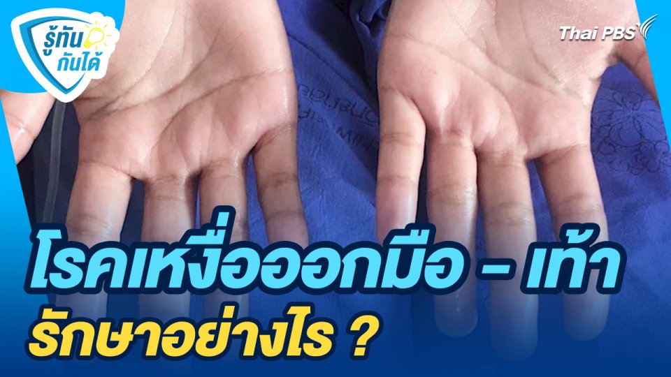 รู้ทันกันได้ : โรคเหงื่อออกมือ - เท้า รักษาอย่างไร ?