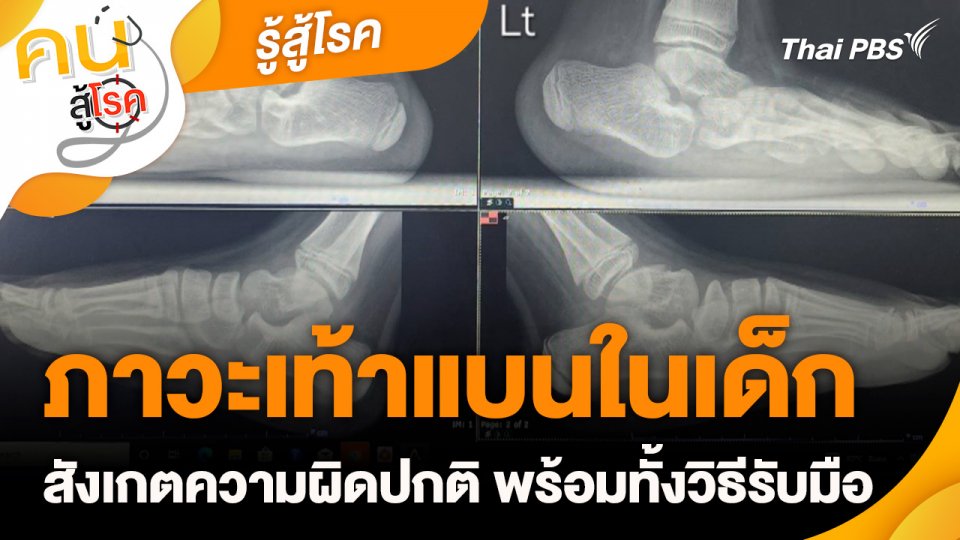 รู้สู้โรค : ภาวะเท้าแบนในเด็ก