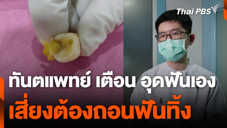ทันตแพทย์ เตือน อุดฟันเอง เสี่ยงต้องถอนฟันทิ้ง