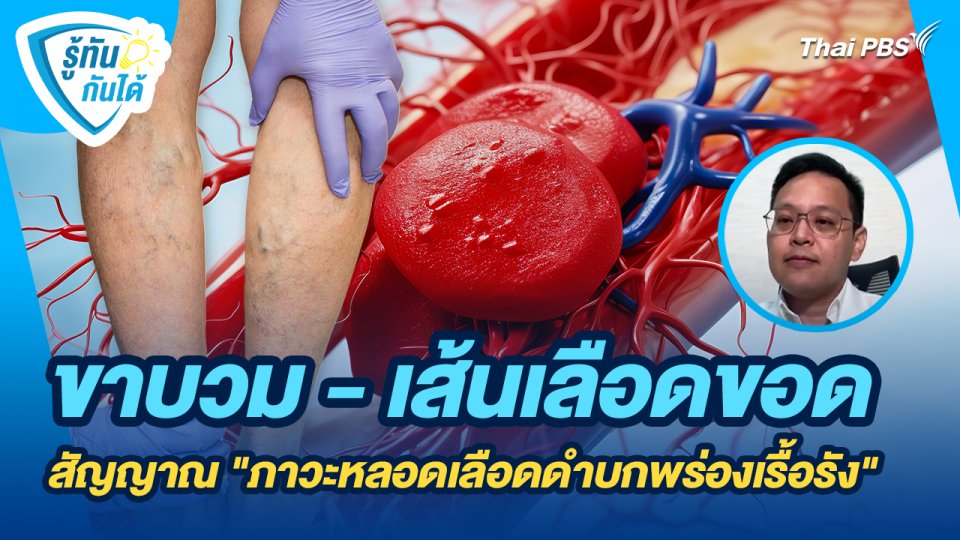 รู้ทันกันได้ : ขาบวม - เส้นเลือดขอด สัญญาณบ่งบอก "ภาวะหลอดเลือดดำบกพร่องเรื้อรัง"