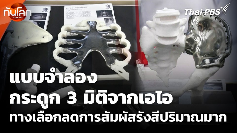 แบบจำลองกระดูก 3 มิติจากเอไอ ทางเลือกลดการสัมผัสรังสีปริมาณมาก