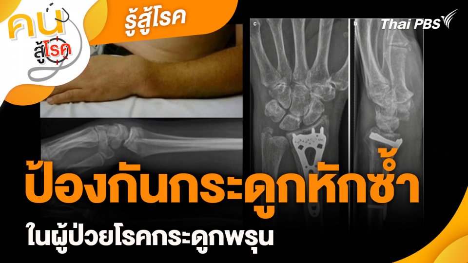 รู้สู้โรค : ป้องกันกระดูกหักซ้ำ ในผู้ป่วยโรคกระดูกพรุน