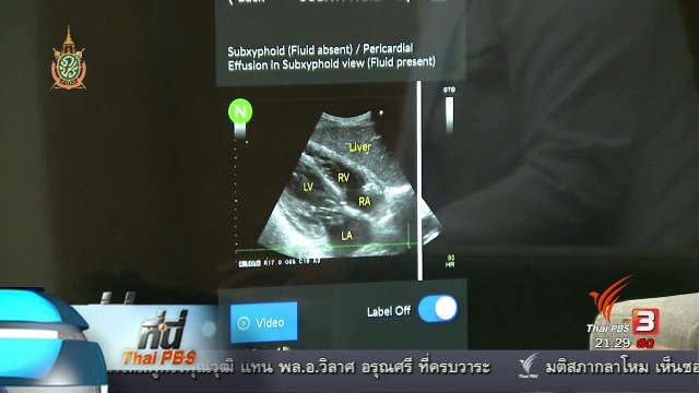 ที่นี่ Thai PBS : แอพลิเคชันช่วยวิเคราะห์ผู้ป่วยวิกฤต