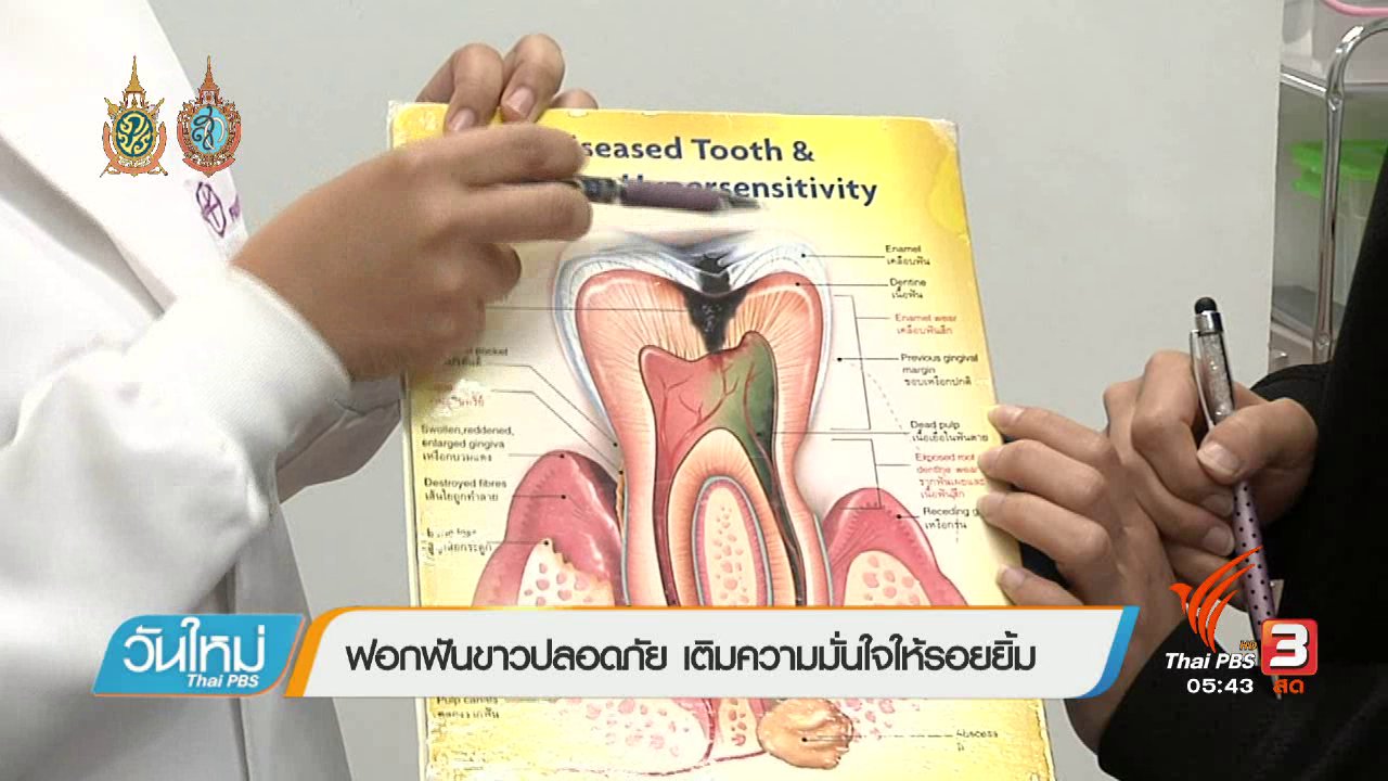วันใหม่ ไทยพีบีเอส - 108 สุขภาพ : ฟอกฟันขาวปลอดภัย เติมความมั่นใจให้รอยยิ้ม