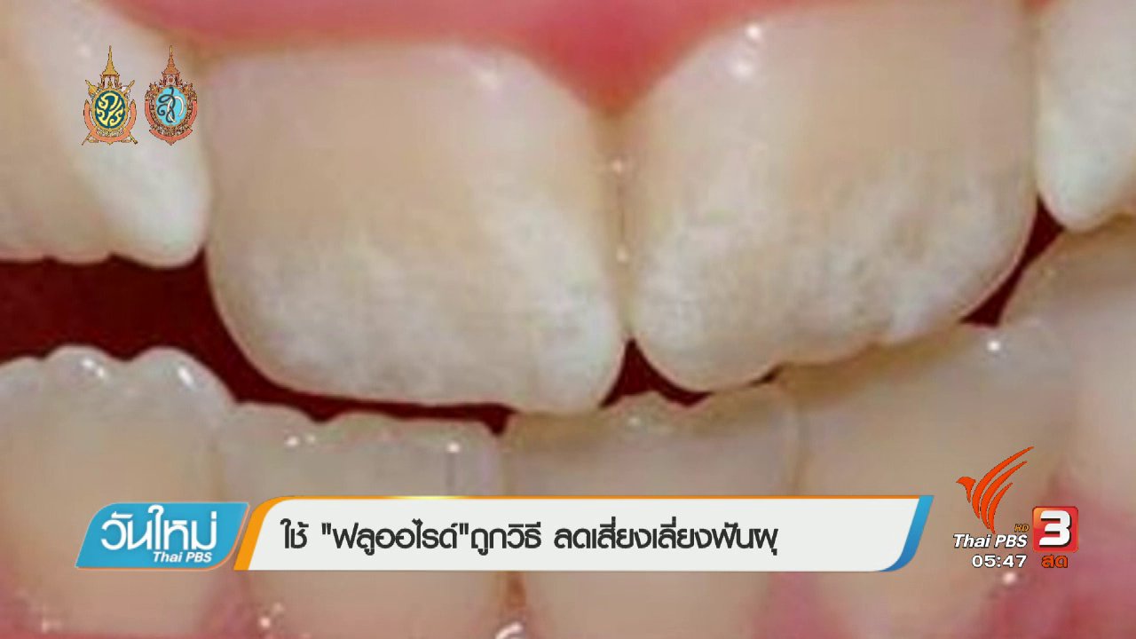 วันใหม่ ไทยพีบีเอส - 108 สุขภาพ : ใช้ "ฟลูออไรด์"ถูกวิธี ลดเสี่ยงเลี่ยงฟันผุ