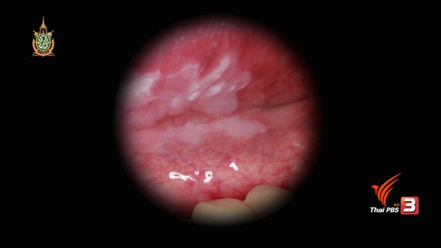 มะเร็งช่องปาก รู้เร็วรักษาได้