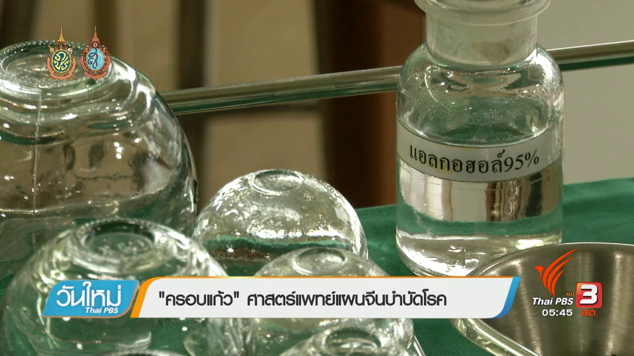 วันใหม่ ไทยพีบีเอส - 108 สุขภาพ : "ครอบแก้ว" ศาสตร์แพทย์แผนจีนบำบัดโรค