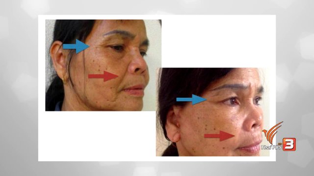 รู้สู้โรค : ศัลยกรรมแก้หนังตาตก