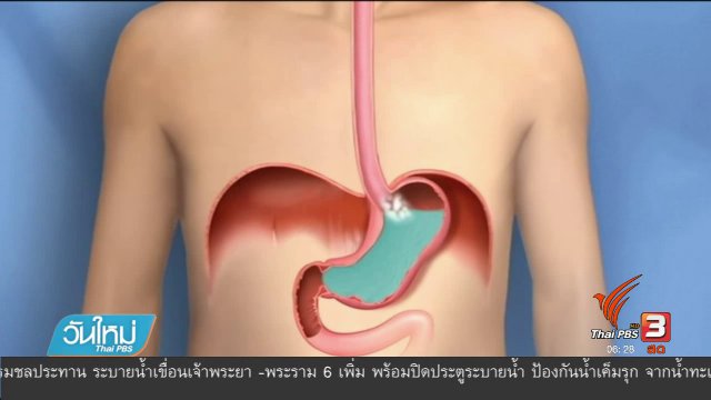 108 สุขภาพ : ปรับพฤติกรรม ป้องกันโรคกรดไหลย้อน