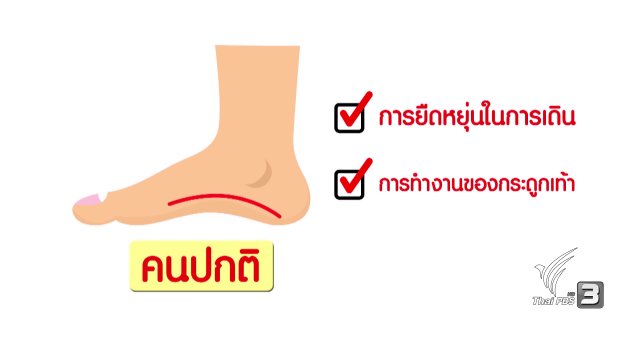 ภัยรอบตัว : เท้าแบนภัยใกล้ตัวผู้หญิง