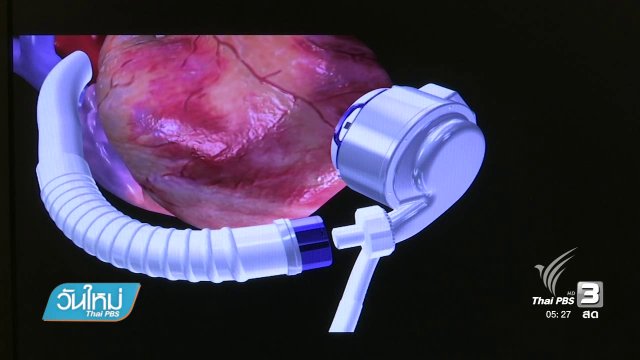 แพทย์รามาฯ ผ่าตัดหัวใจเทียมสำเร็จในไทย