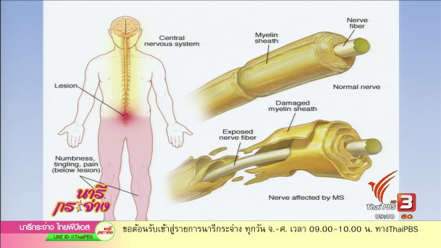 "ปลอกประสาทอักเสบ" โรคร้ายวัยทำงาน