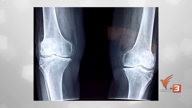 ปรับก่อนป่วย : 5 เทคนิคดูแลตัวเอง ป้องกันข้อเข่าเสื่อม