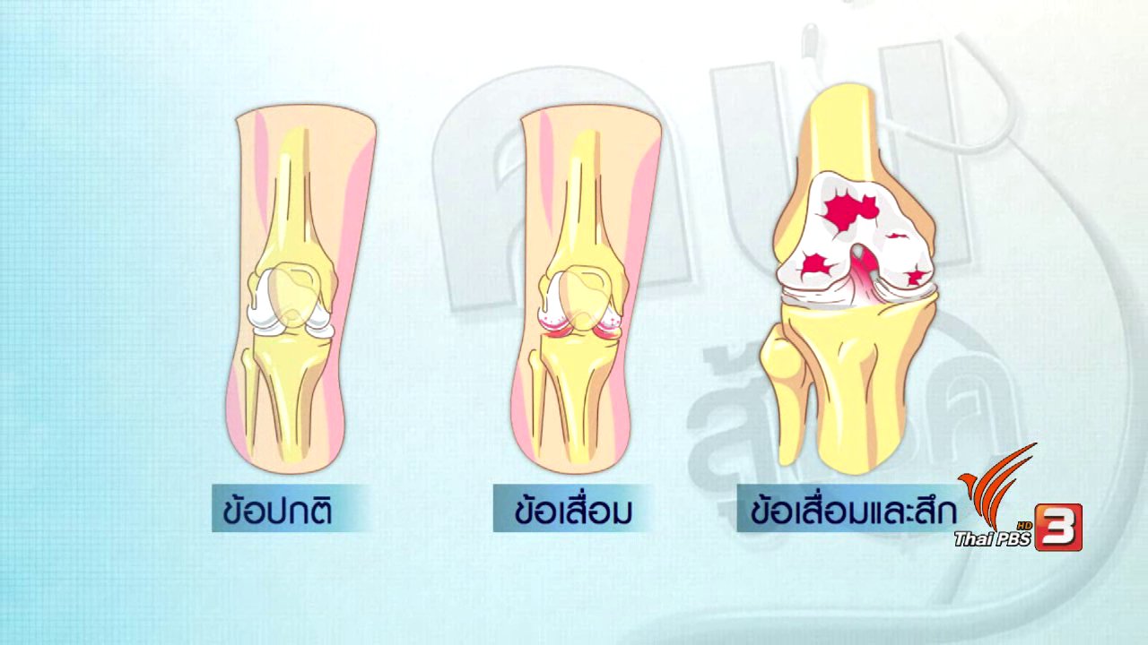 คนสู้โรค - ปรับก่อนป่วย : กายภาพบำบัดแก้อาการข้อเข่าเสื่อม