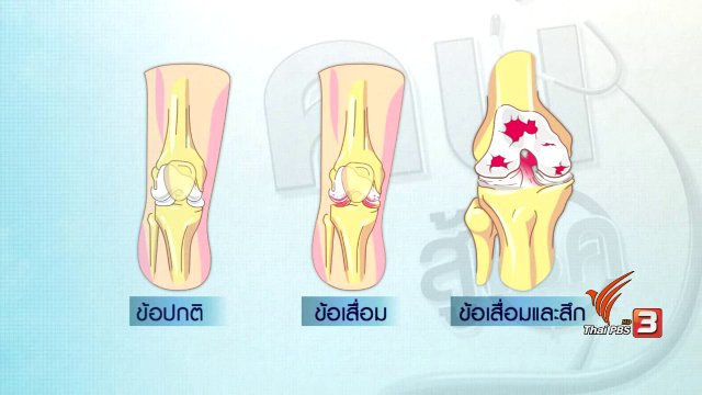 ปรับก่อนป่วย : กายภาพบำบัดแก้อาการข้อเข่าเสื่อม